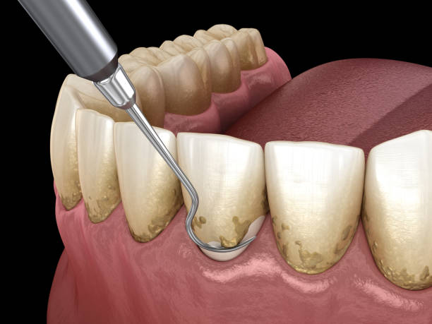Periodontal Therapy in Jackson, MS | Periodontal Therapy Near Me