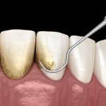 periodontal therapy